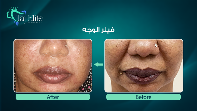 before-^-after15